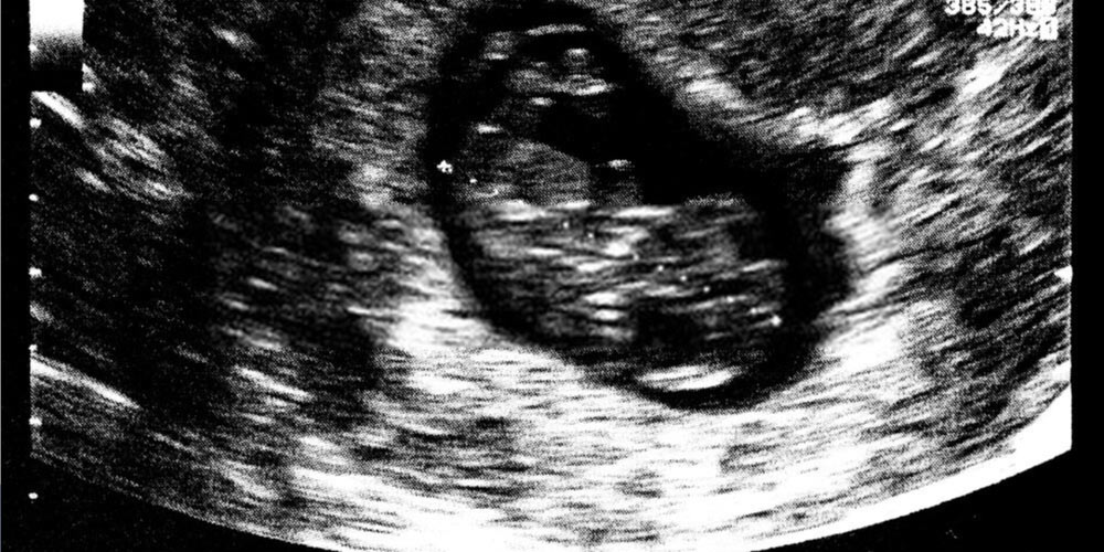 Ultrasound in Week 7 of Pregnancy