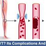 What-Is-DVT-Its-Complications-And-Treatment