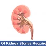 What-Size-Of-Kidney-Stones-Require-Surgery