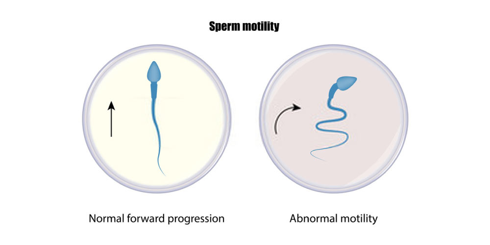 abnormal sperm