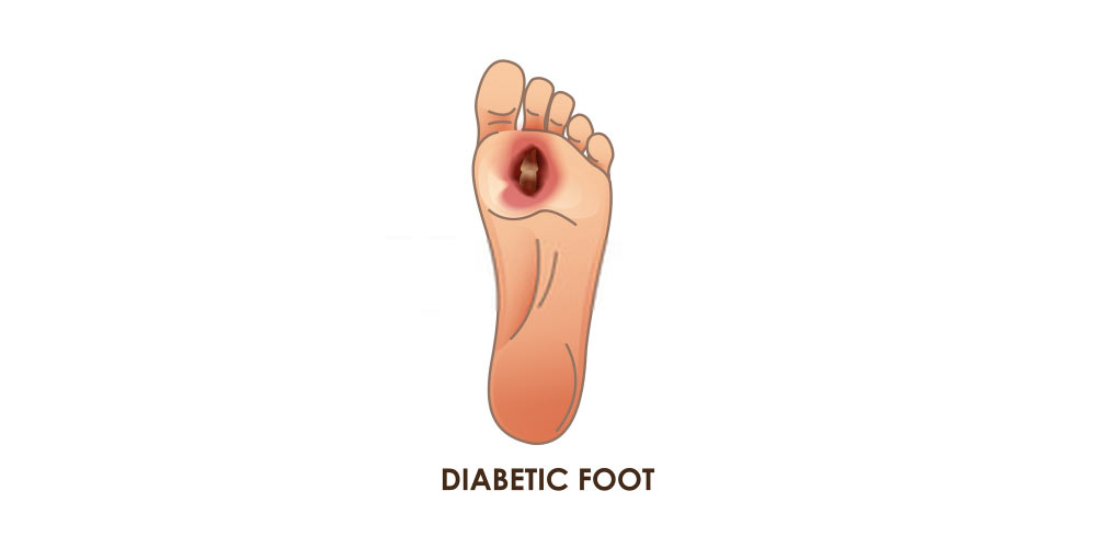 diabetic foot ulcer infection