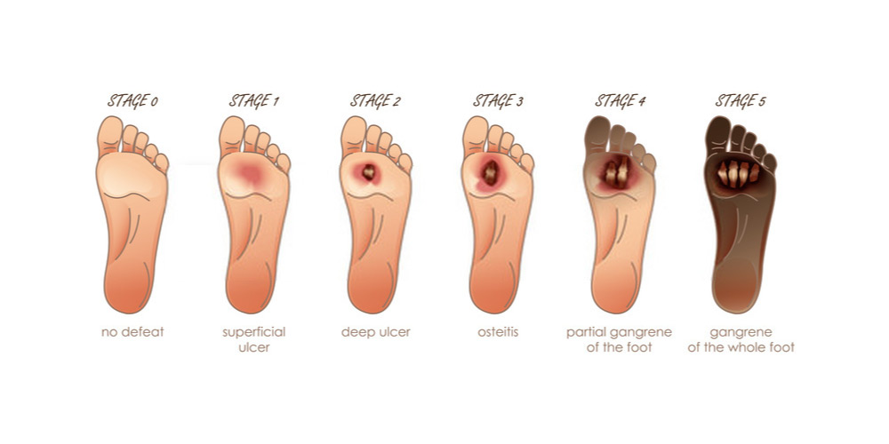 different stages of diabetic foot ulcers