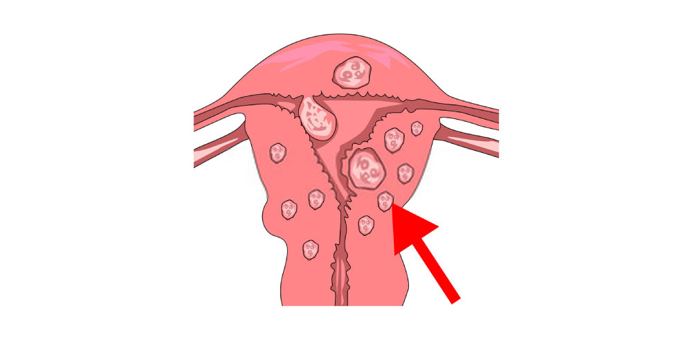 fibroids on the walls of the uterus