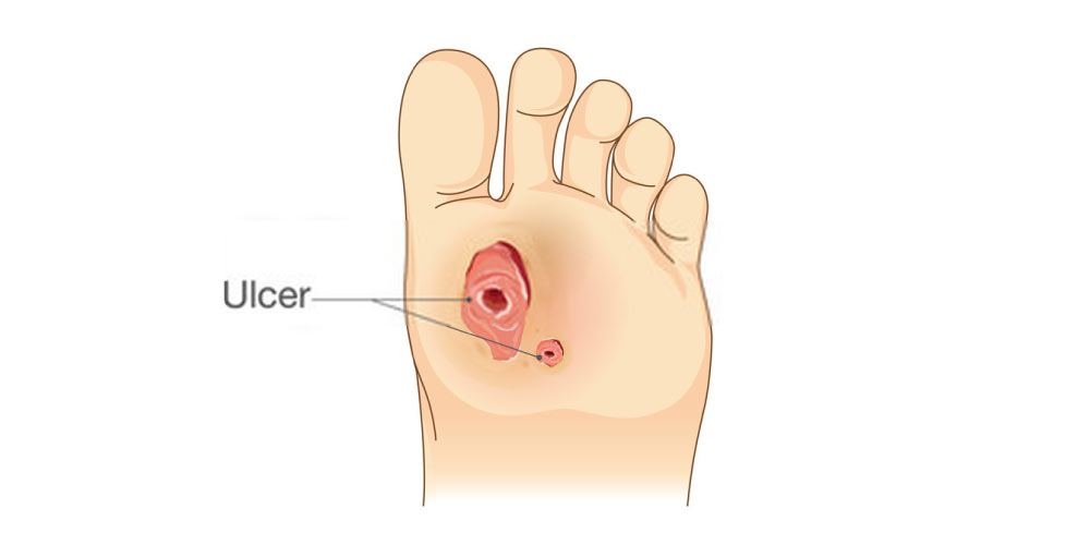 foot ulcers due to diabetes