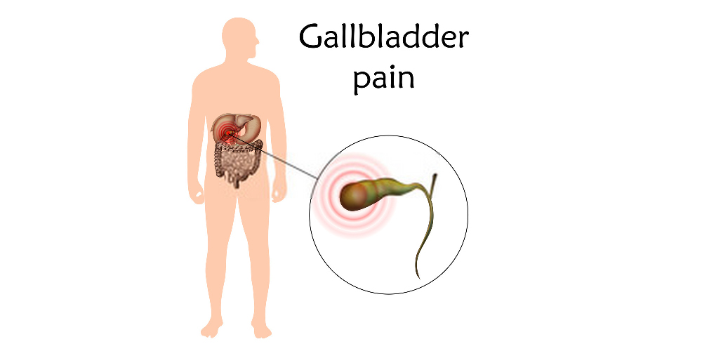gallbladder stones