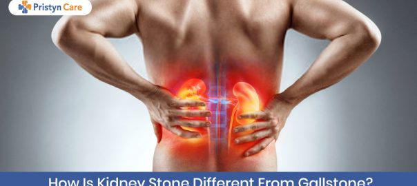 How Is Kidney Stone Different From Gallstone?