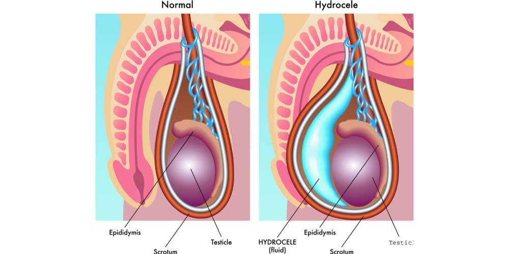 hydrocele- swelling in the scrotum