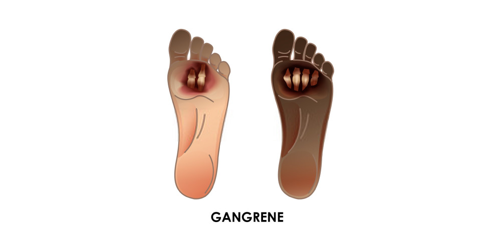 partial gangrene in foot-diabetic foot ulcer