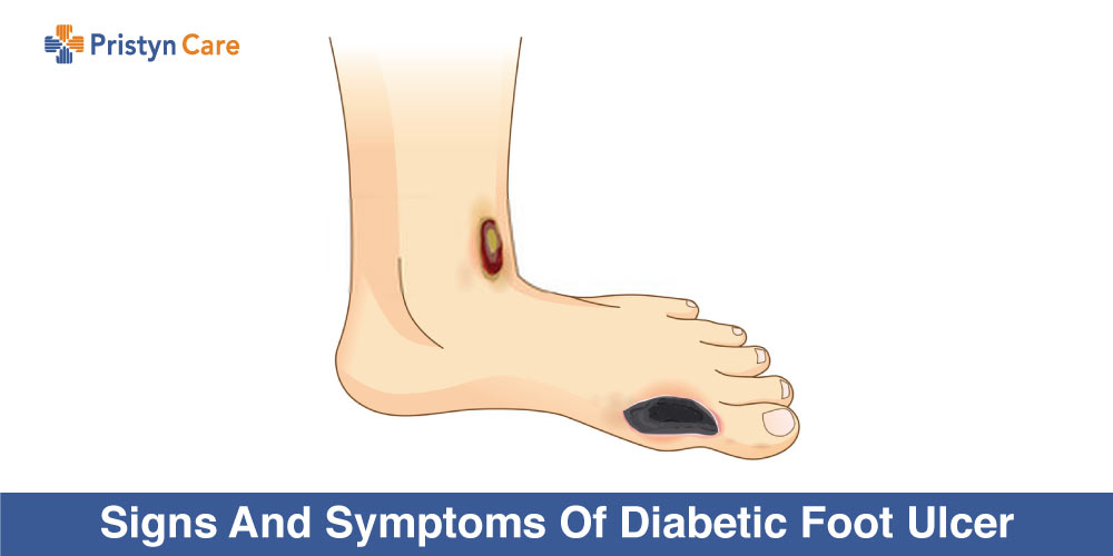 signs and symptoms of diabetic foot ulcer