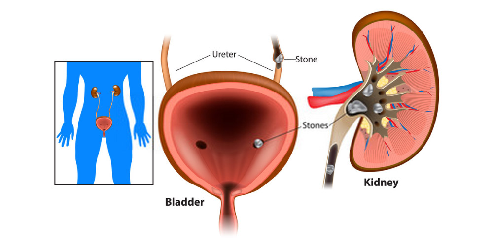 stone in the bladder