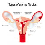 types of uterine fibroids