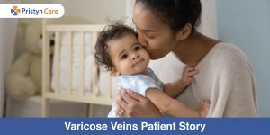 varicose veins patient story