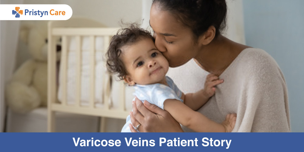 varicose veins patient story