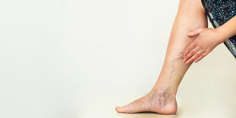 woman with varicose veins in legs