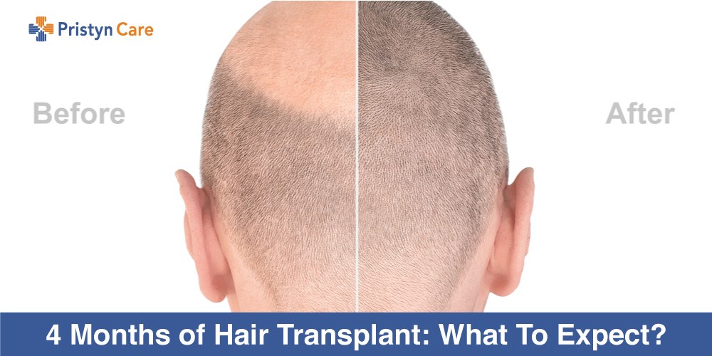 3 Best Hair Transplant Surgeons in Vadodara GJ  ThreeBestRated