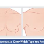 7-Types-of-Gynecomastia-Know-Which-Type-You-Are-Suffering-From