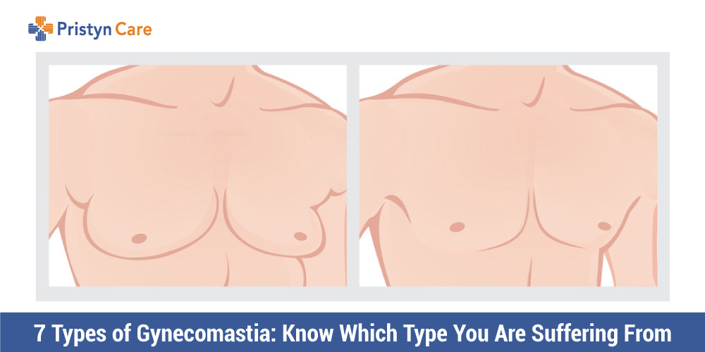 7-Types-of-Gynecomastia-Know-Which-Type-You-Are-Suffering-From