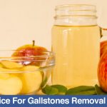 Apple juice for gallstones removal naturally