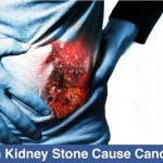 Can-Kidney-Stone-Cause-Cancer