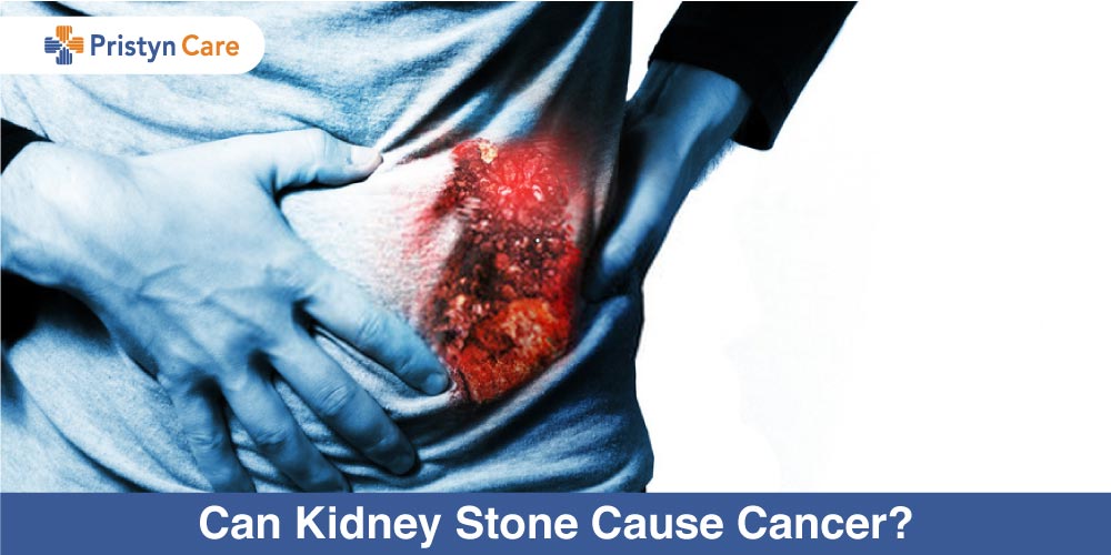 Can-Kidney-Stone-Cause-Cancer