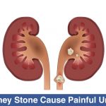 Can-Kidney-Stone-Cause-Painful-Urination