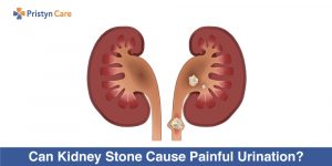 Can-Kidney-Stone-Cause-Painful-Urination