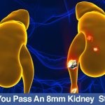 Can-You-Pass-An-8mm-Kidney-Stone