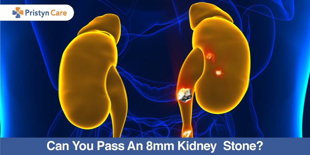 Can-You-Pass-An-8mm-Kidney-Stone