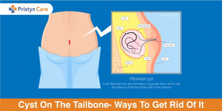 Cyst-On-The-Tailbone--Ways-To-Get-Rid-Of-It