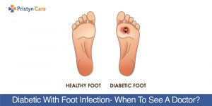 Diabetic-With-Foot-Infection-When-To-See-A-Doctor