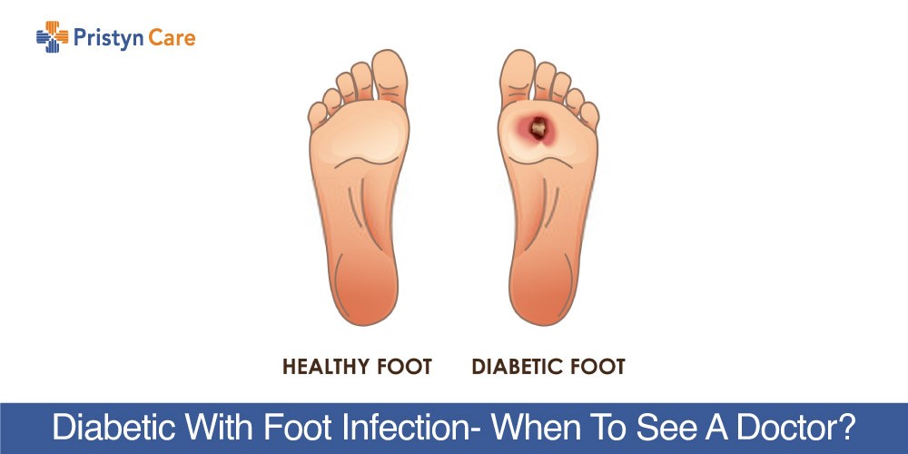 Diabetic-With-Foot-Infection-When-To-See-A-Doctor