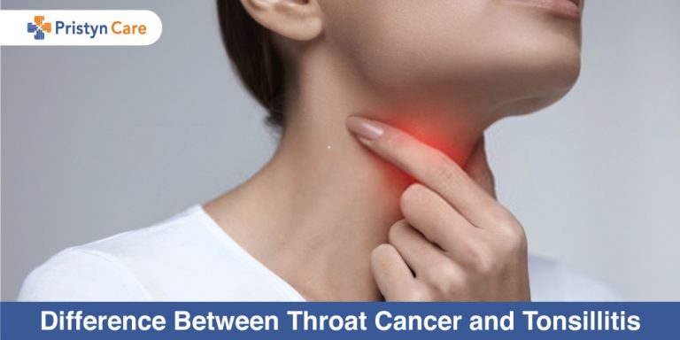 Difference-Between-Throat-Cancer-and-Tonsillitis
