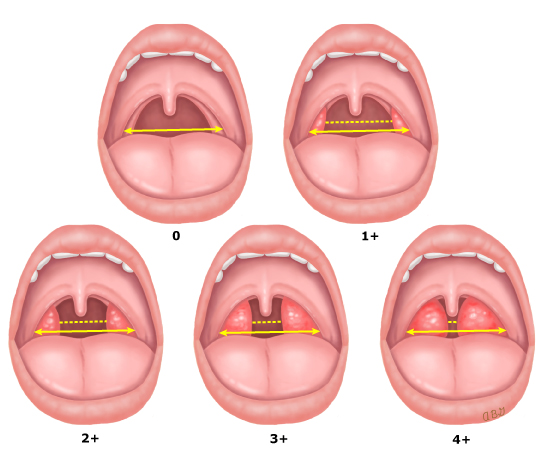 Grading_of_tonsil_size