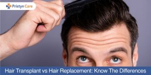 Hair-Transplant-vs-Hair-Replacement-Know-The-Differences