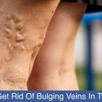How-To-Get-Rid-Of-Bulging-Veins-In-The-Legs