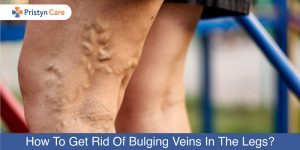 How-To-Get-Rid-Of-Bulging-Veins-In-The-Legs