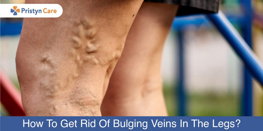 How To Get Rid Of Bulging Veins In The Legs? - Pristyn Care