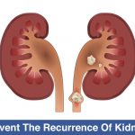 How-To-Prevent-The-Recurrence-Of-Kidney-Stones