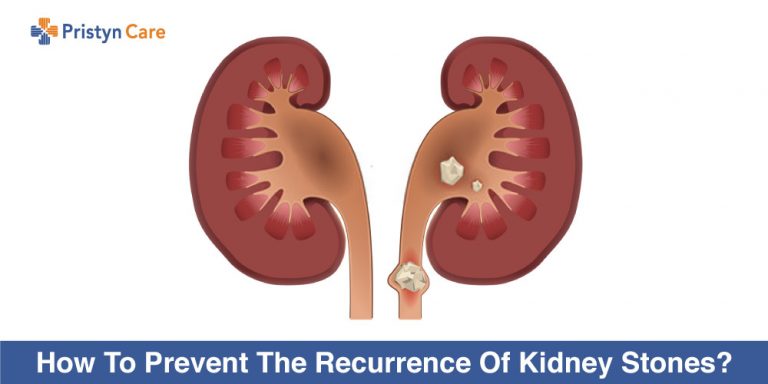 How-To-Prevent-The-Recurrence-Of-Kidney-Stones