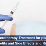 Sclerotherapy Treatment for piles