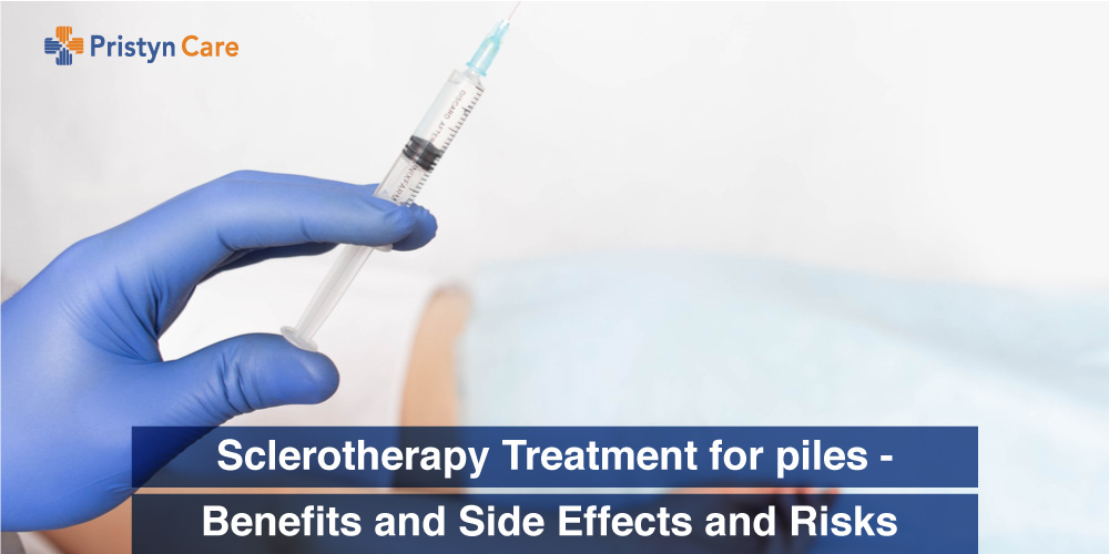 Sclerotherapy Treatment for piles