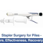 Stapler Surgery For Piles