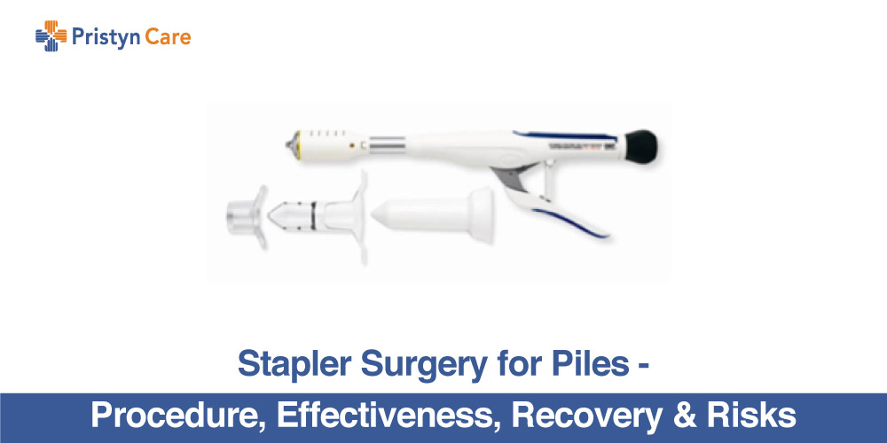 Stapler Surgery For Piles
