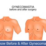 Things-to-Know-Before-and-After-Gynecomastia-Surgery-2
