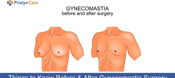 Things to Know Before and After Gynecomastia Surgery