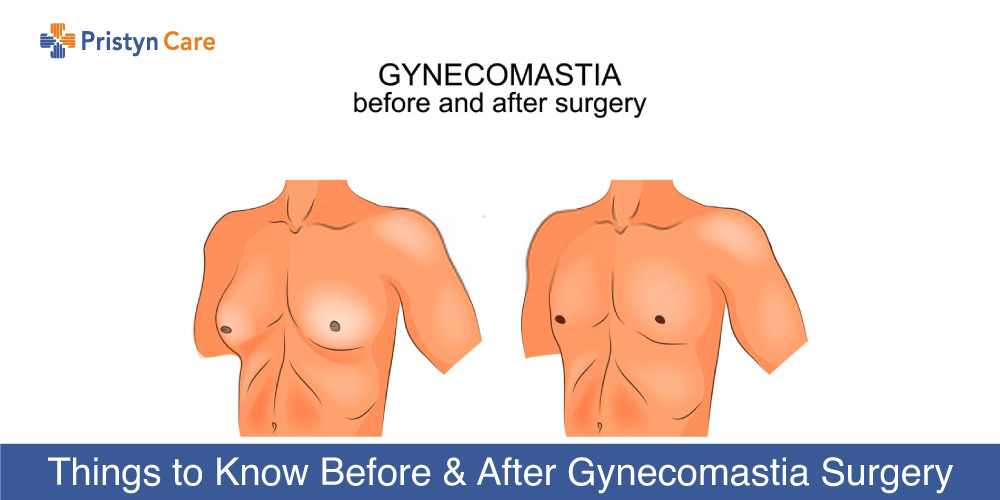 Things to Know Before and After Gynecomastia Surgery - Pristyn Care