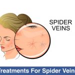 Treatments-For-Spider-Veins