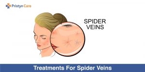 Treatments-For-Spider-Veins