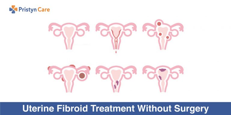Uterine-Fibroid-Treatment-Without-Surgery
