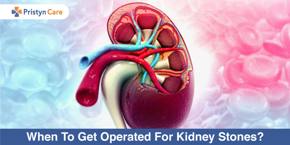 When-To-Get-Operated-For-Kidney-Stones